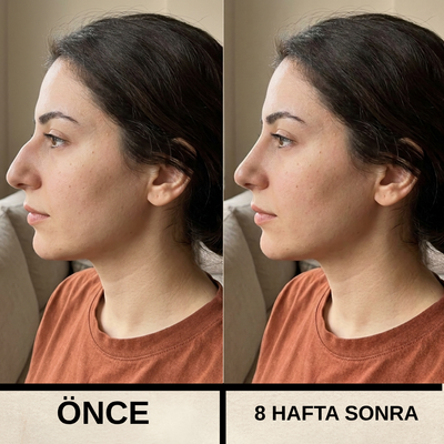 Formella Burun Şekillendirme Cihazı